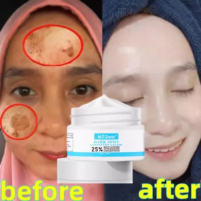 Strong Removal Melasma Whitening Cream Freckle Speckle Spots Melanin Pigment US • $8.95