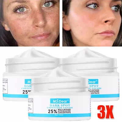 3x Strong Removal Melasma Whitening Cream Freckle Speckle Spots Melanin Pigment • £11.45