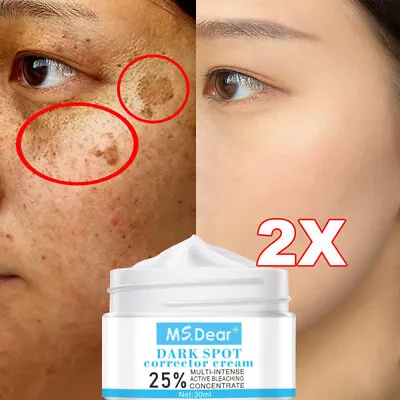 2x Removal Melasma Whitening Cream Dark Spot Remover Freckle Speckle Cream • £9.95