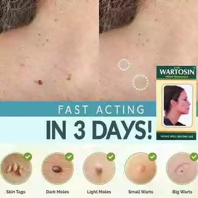 New Skin Tag Remover Cream Safe Fast Wart Removal Mole Acne Pimple Patch Spot Us • $8.99