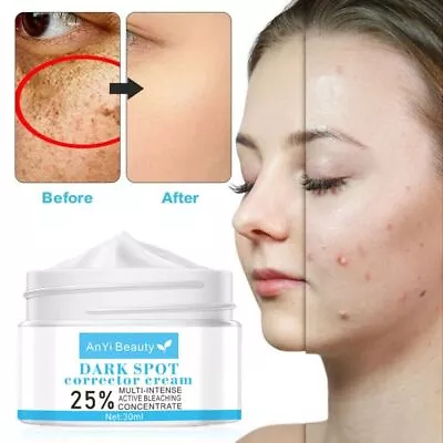 Strong Removal Melasma Whitening Cream    Dark Spot Remover Freckle Speckle • £4.75