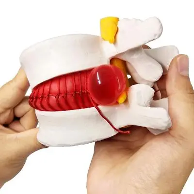 Anatomical Lumbar Disc Bulging Spine Lumbar Vertebrae Disc Herniated Model White • $19.85