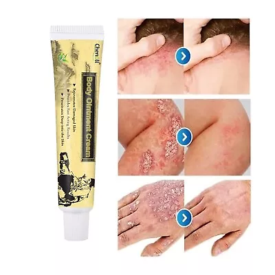 Crema Para Dermatitis Eczema Psoriasis Para Comezon Picazon Ronchas En La Piel • $17.98