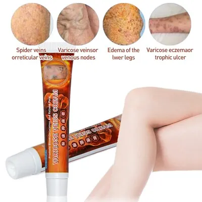 100%Original Vasculitis Blood Circulation Varicose Veins Treatment New Cream 20g • £4.67