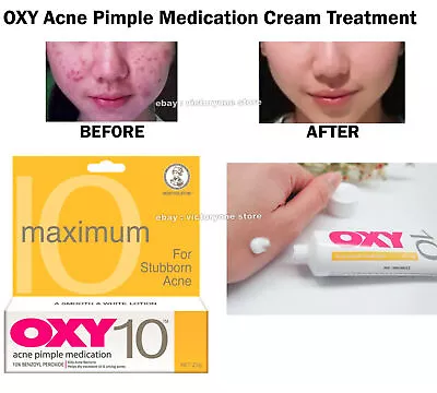 Treatment Face Acne Pimple Medication Cream OXY 10 Benzoyl Peroxide Easy To Use • $143.91