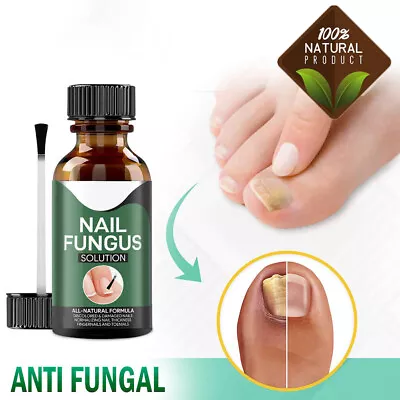 Anti Fungal Treatment Extra Strength Toenail Fungus Athletes Foot Fungi Nail  • $6.99