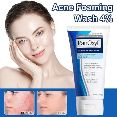 New Acne Foaming Wash Face & Body 156g Peroxide All Skin Types 5.5oz UK • £8.59