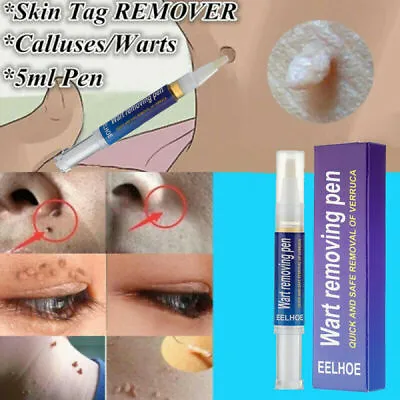 12 Hours Skin Tag Mole Wart Remover Pen Foot Corn Treatment Cream Eliminate US • $9.28