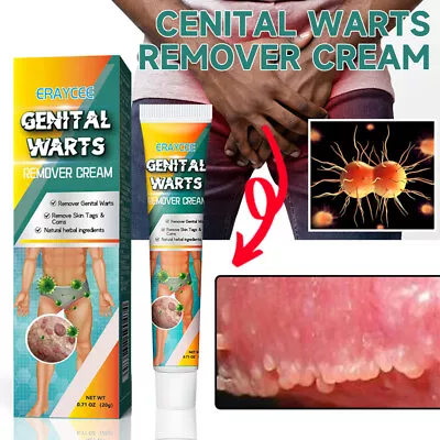 Genital Herpes Wart Remover Ointment Skin Tag Mole Acuminatum Treatment Cream UK • £7.89