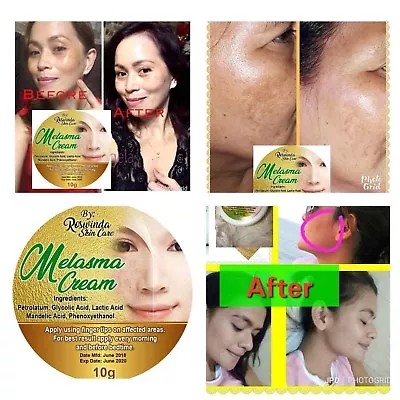 Melasma Remover Cream Freckles Dark Spot Diminish Sun Damage Micro Peeling • $8