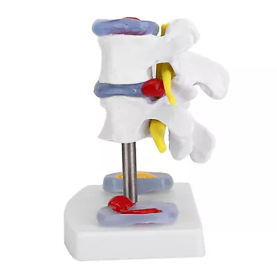Anatomical Lumbar Disc Herniation Demonstration Model Human Spine School US • $13.33