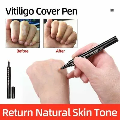 Vitiligo Cover Pen Scars Birthmarks Waterproof White Spots Camouflage Makeup New • $14.49