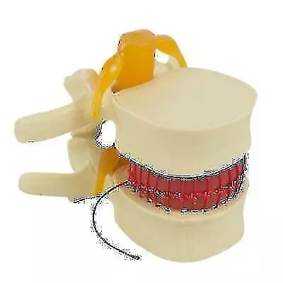 Premium Lumbar Spine Disc Anatomy Model For Medical Education - • $23.99