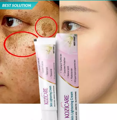 Strong Removal Melasma Whitening Cream Sunburn Spots Pigment Freckle Speckle • $15.97