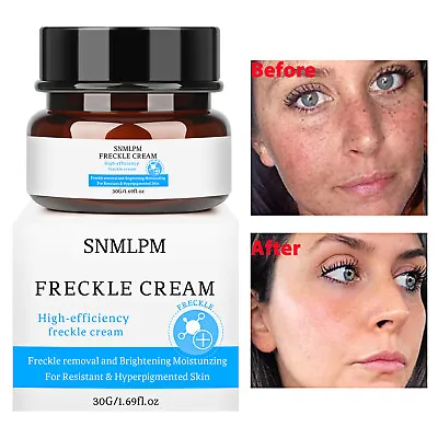 $8.99 • Buy Whitening Freckle Cream Remove Melasma Pigment Melanin Acne Spot Dark Spots