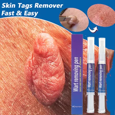 2Pack 12 Hours Wart Remover Pen Skin Tag Mole Remover Eliminate Foot Corn Warts • $10.12