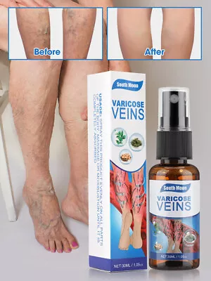 Varicose Veins Cream Relief Phlebitis Angiitis Varices Inflammation Care Spray • $8.99