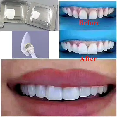 Teeth Veneer Dental Veneers Tooth Whitening Ceramic Anterior LMS • $8.55