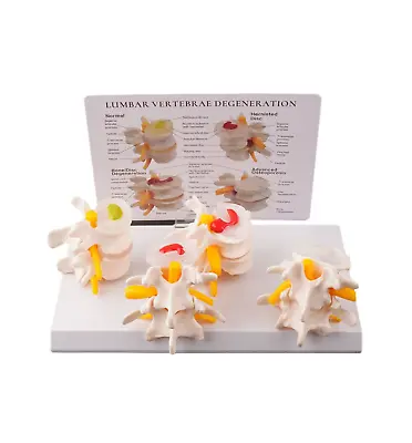 New Sick Human Lumbar Vertebrae Degenerative Disc Disease Model Anatomical • $37.50