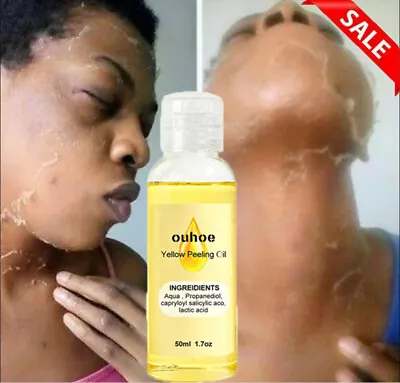 Extra Strength Yellow Peeling Oil Lightening Exfoliating Dark Skin For Body Face • $9.28