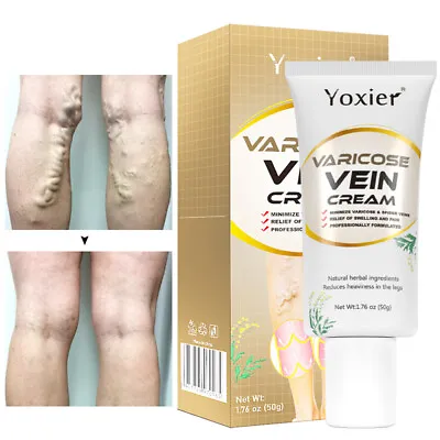 Varicose Veins Miracle Cream Vasculitis Legs Treatment Skin Ointment Foot Care • £6.71