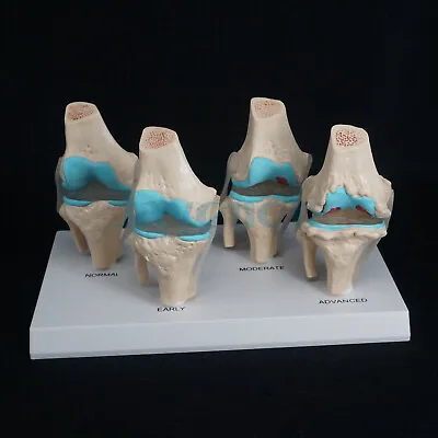 Anatomical Human Degenerative Knee Joint Disease Model Medical Skeleton Anatomy • $33.40