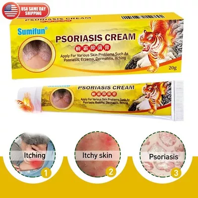 Full Body Health Care Psoriasis Cream Eczema Ointment Scalp Psoriasis Hand Tinea • $9.99