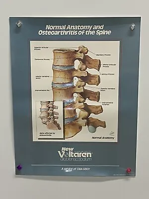 Human Normal Anatomy & Osteoarthritis Spine Vertebrae Poster Voltaren 19  X 15  • $12.99