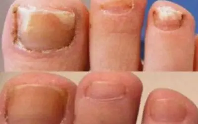 Stronger Fungal Treatment Lotion Kills 99.9% Skin Nail Fungus Toes FOOT & HAND  • £5.79