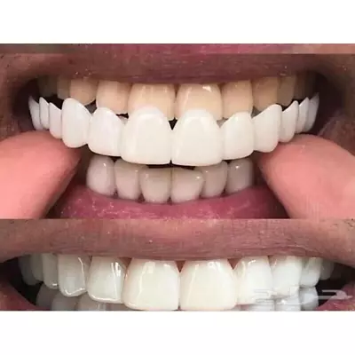 $14.95 • Buy Smile Snap On UpperBottom Teeth Denture Veneers Set Eat False Dental Tooth Cover
