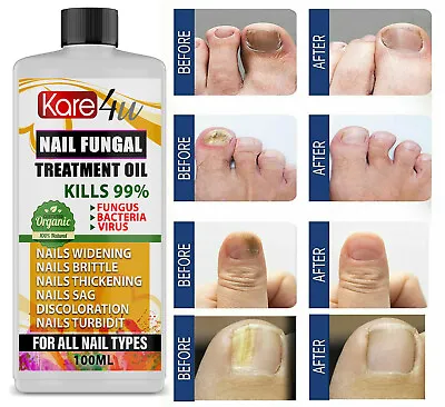 £3.95 • Buy Anti Fungal Treatment Fungus Effective Finger Toe Nail Repair Liquid Solution UK