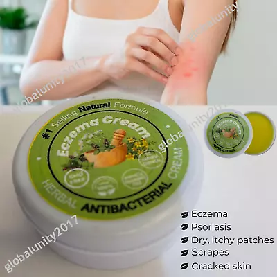 Dermatitis Eczema Cream Antibacterial Itchy Rash Dry Skin Rosacea Treatment Balm • $24.89