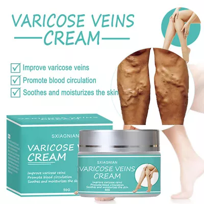 Varicose Veins Relief Cream Vasculitis Phlebitis Spider Pain Relief Ointment UK • £9.95