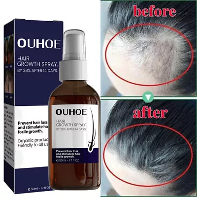 Blusoms Hairgrowth Formula Serum Spray Hair Growth Spray Hair Focile Regrowth US • $9.28