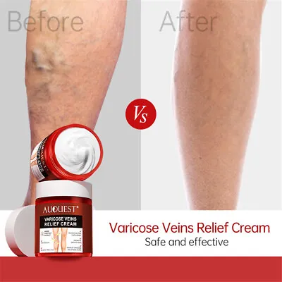 Removal Varicose Veins Treatment Cream Anti Spider Stretch Marks Vasculitis New • £9.49