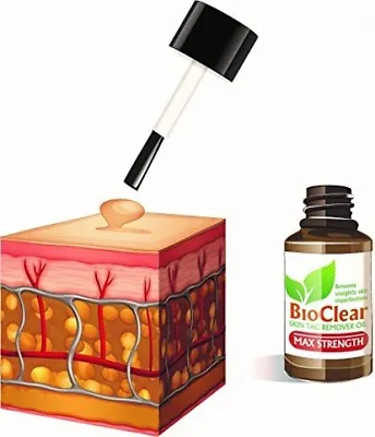 Bio Clear Skin Tag Wart Remover Max Strength 15ml Removal Dries & Drops Off • £14.99