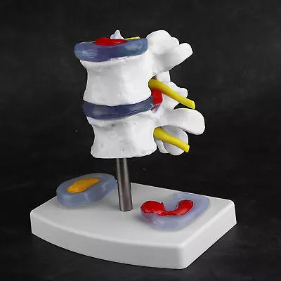 Anatomical Lumbar Disc Herniation Model Human Spine School Training Supplies • $17.29