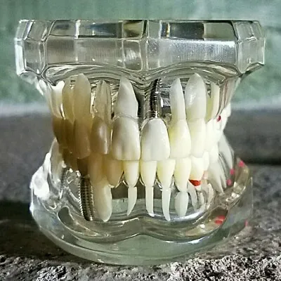 Disease Teeth Model Clear Dental Teeth Model Vintage Medical Oddities Weird • $40