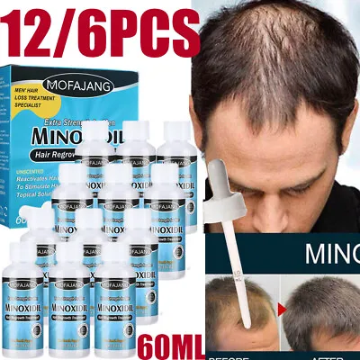 £6.85 • Buy Hair Regrowth Extra Strength 5% 1 To 12 MONTH SUPPLY Topical HAIR LOSS TREATMENT