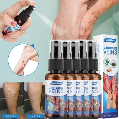 5X Veinhealing Varicose Veins Treatment Spray For Legs Improve Blood Circulation • $8.78