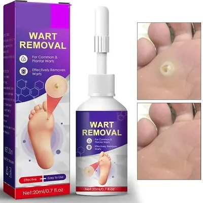 Foot Corn Removal Liquid | Painless Treatment | Genital Warts Calluses • £5.99