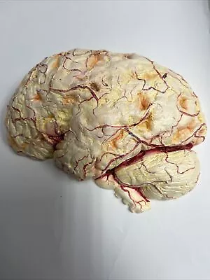 Vintage Brain Anatomical Pathology Model Demonstrating Meningitis • $49.95