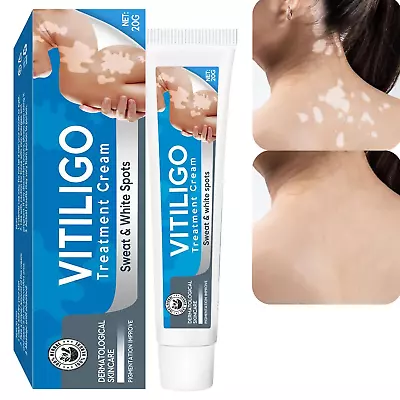 Vitiligo Treatment Vitiligo Cream Improve Skin Pigmentation & Reduces White Spo • $23.67