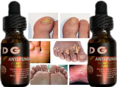 Fungi Athlete's Foot Antifungal Support Jock Itch Ringworm Itching Anti Fungus • $15