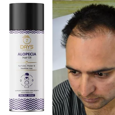 7 Days Alopecia Hair Oil For Hair Fall Control Hair Growth -100ml • $26.61