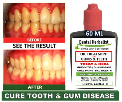 £6.99 • Buy TREAT GUM DISEASE FAST Stops Gingivitis & Receding Gums | Herbal Mouthwash 60 ML