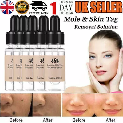 12Hours Wart Remover Pen Skin Tag Mole Remover Eliminate Foot Corn Warts Unisex~ • £12.95