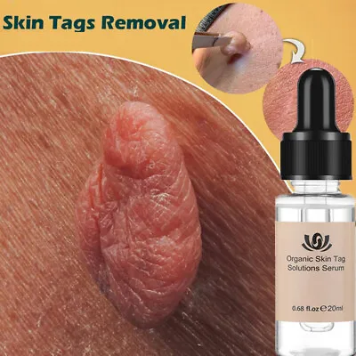 $11.85 • Buy 12Hours Wart Remover Pen Skin Tag Mole Remover Eliminate Foot Corn Warts Unisex~