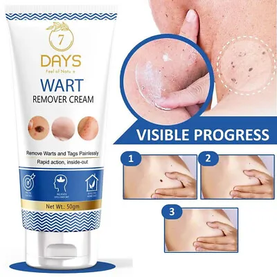 Genital Wart Removal Treatment Cream. Discreet Free Packaging Included 50g. • £16.79