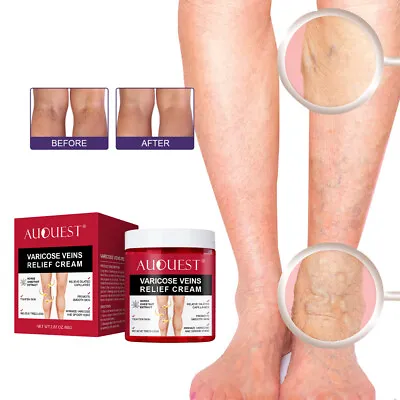 Varicose Veins Relief Cream Relieve Tired Leg Spider Pain Tighten Smooth Skin UK • £8.99